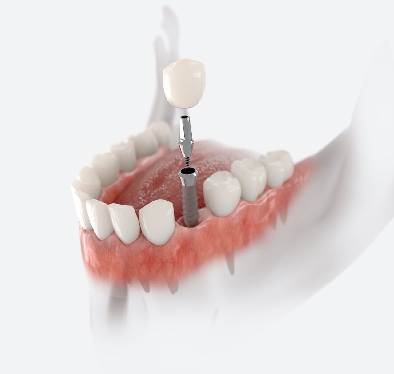 https://rddentalclinic.com/wp-content/uploads/2024/07/DENTAL-IMPLANT.jpg