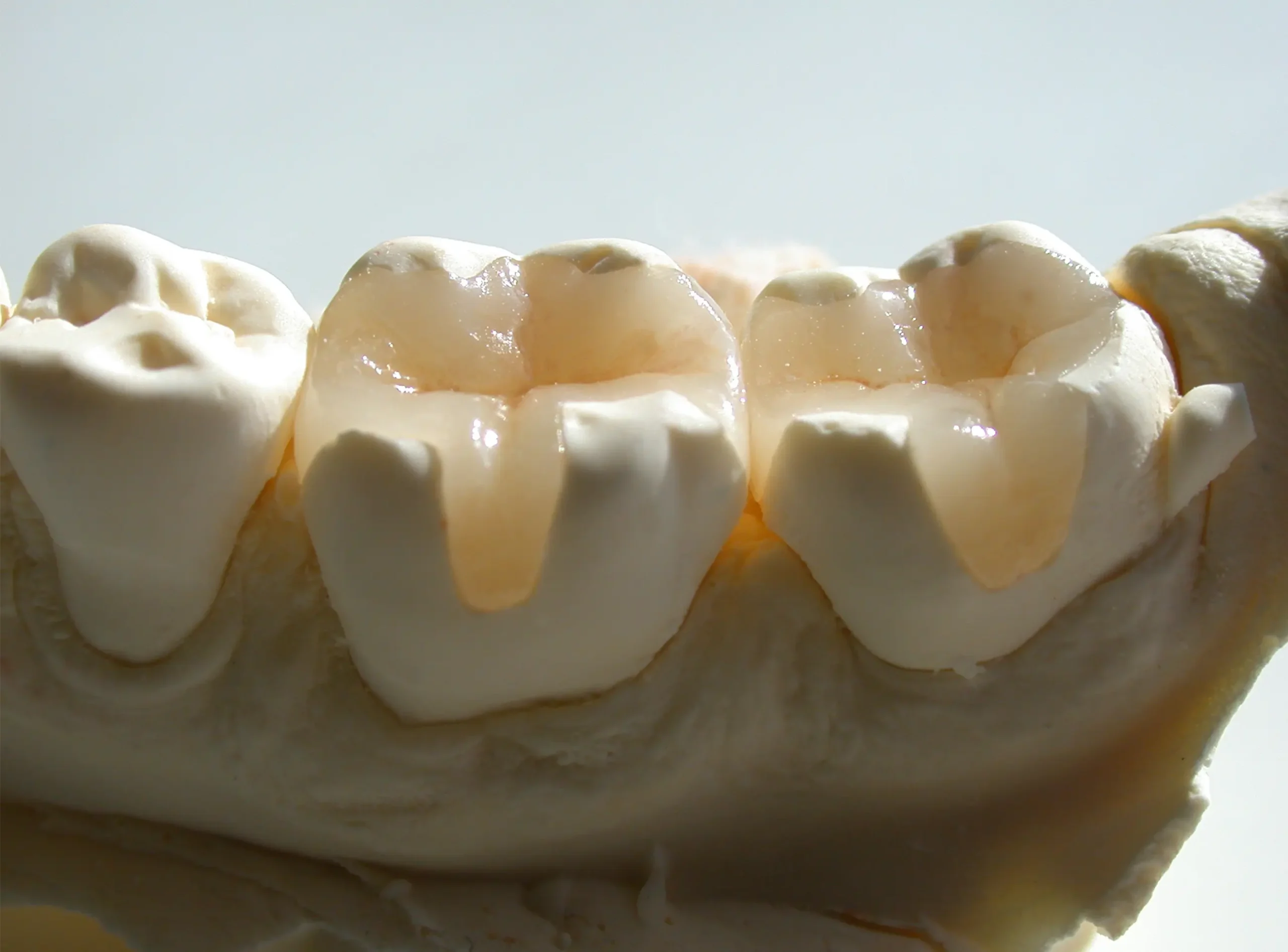 https://rddentalclinic.com/wp-content/uploads/2024/07/INLAYS-ONLAYS-scaled.webp