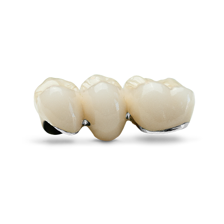 https://rddentalclinic.com/wp-content/uploads/2024/07/PFM-Restorations.png