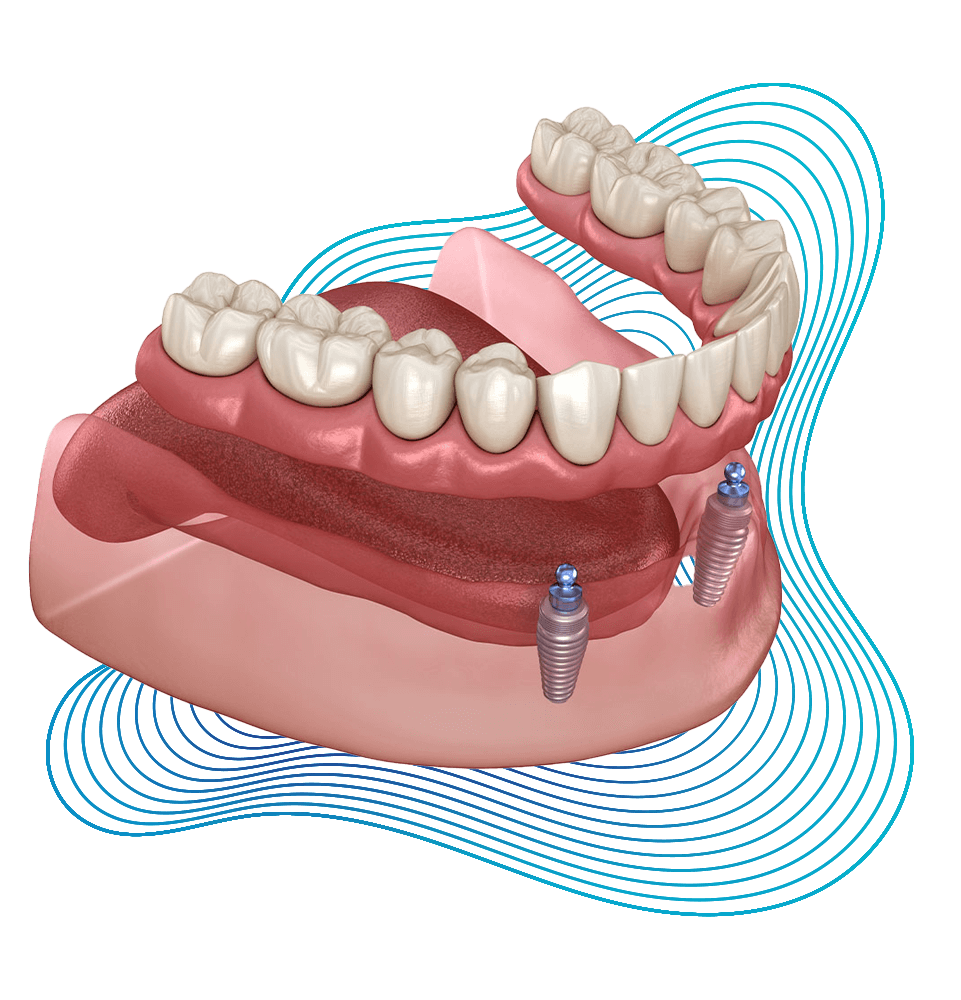 https://rddentalclinic.com/wp-content/uploads/2024/07/Remobable-Dentures.png