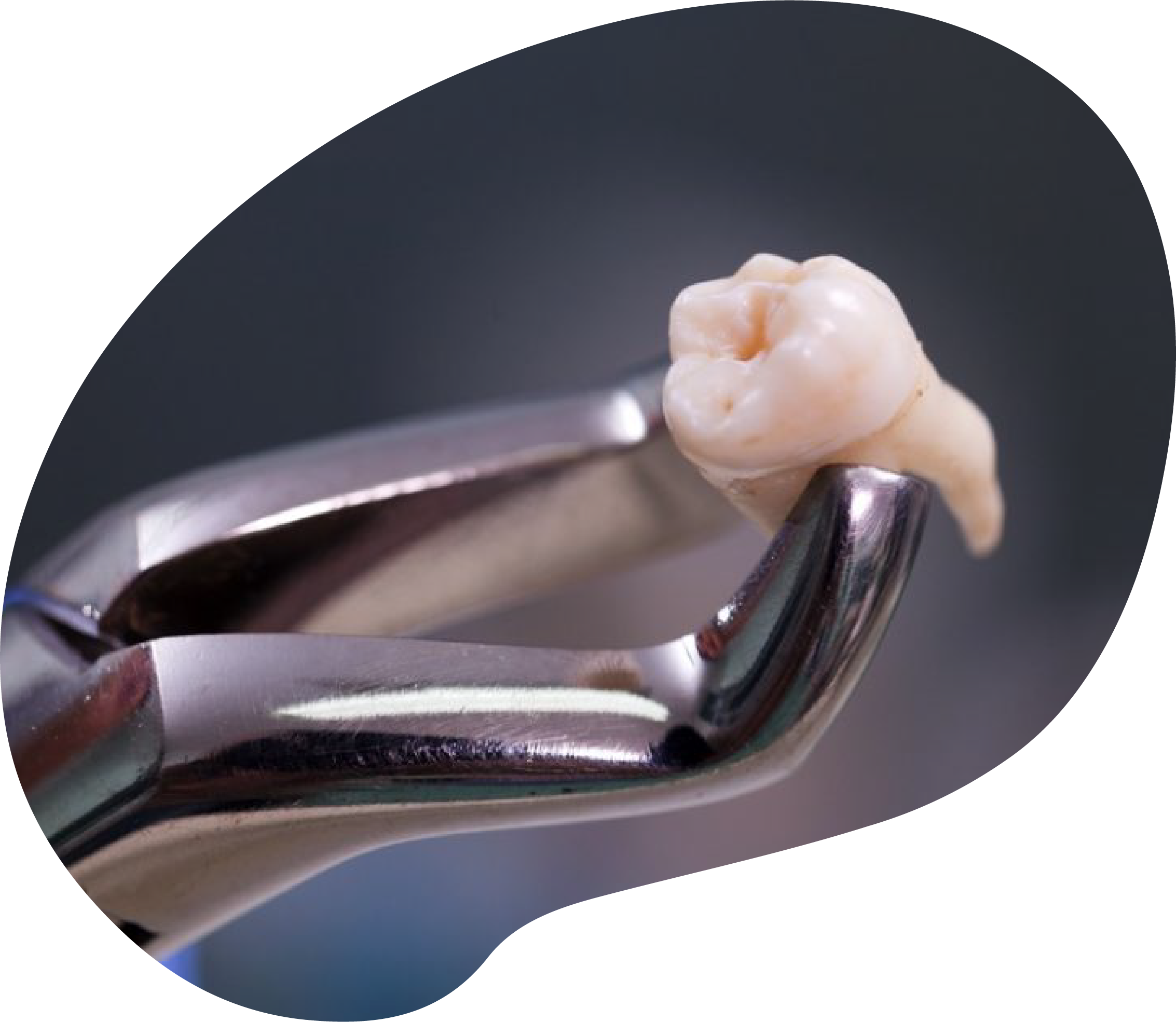 https://rddentalclinic.com/wp-content/uploads/2024/07/TOOTH-Extractions.png