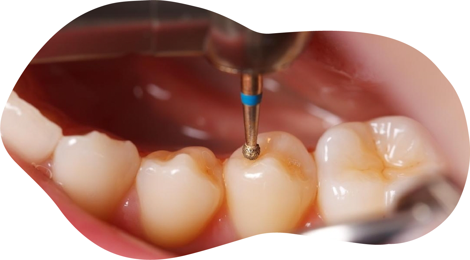 https://rddentalclinic.com/wp-content/uploads/2024/07/Tooth-colored-filling.png