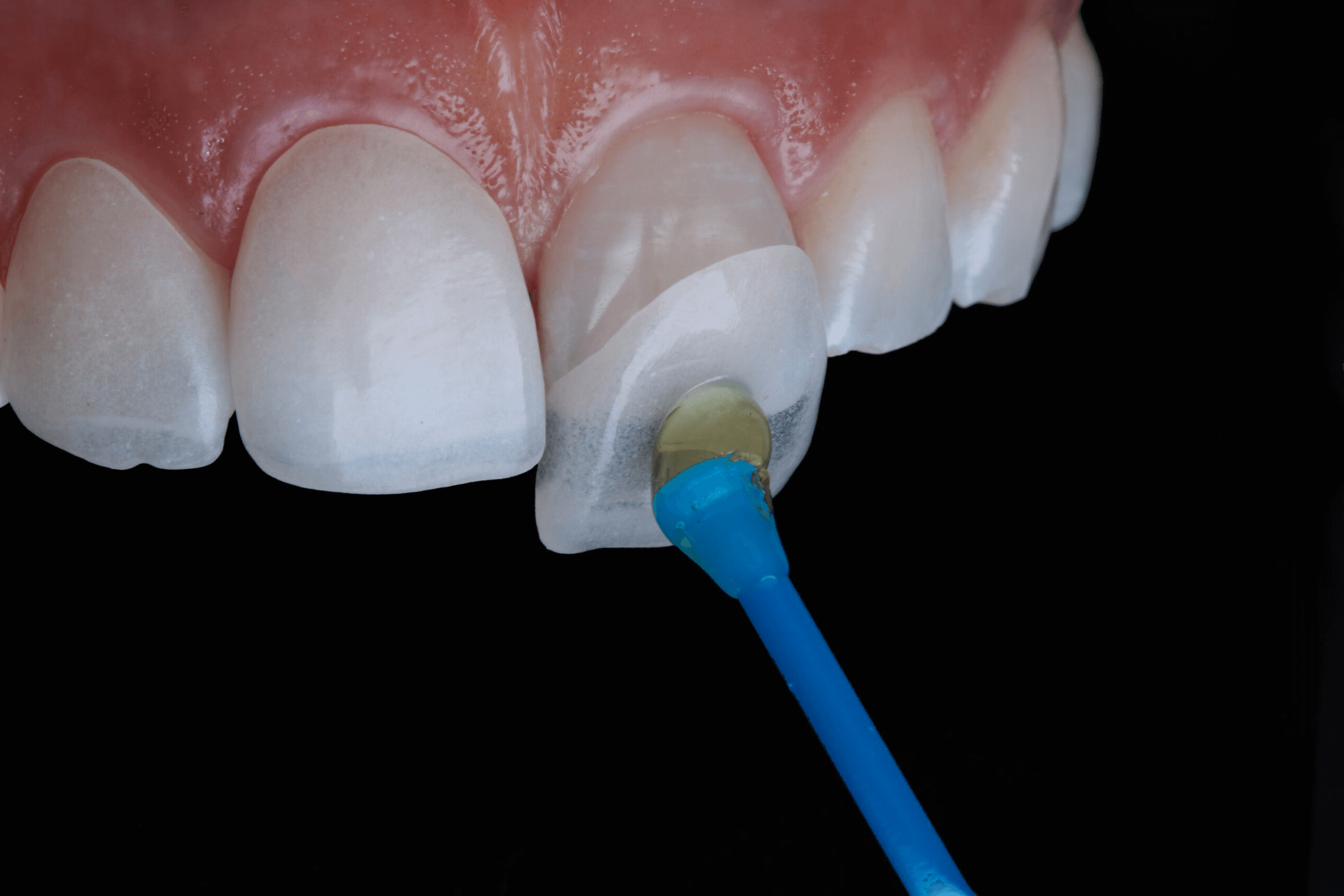 https://rddentalclinic.com/wp-content/uploads/2024/07/Veeners-Laminates.png