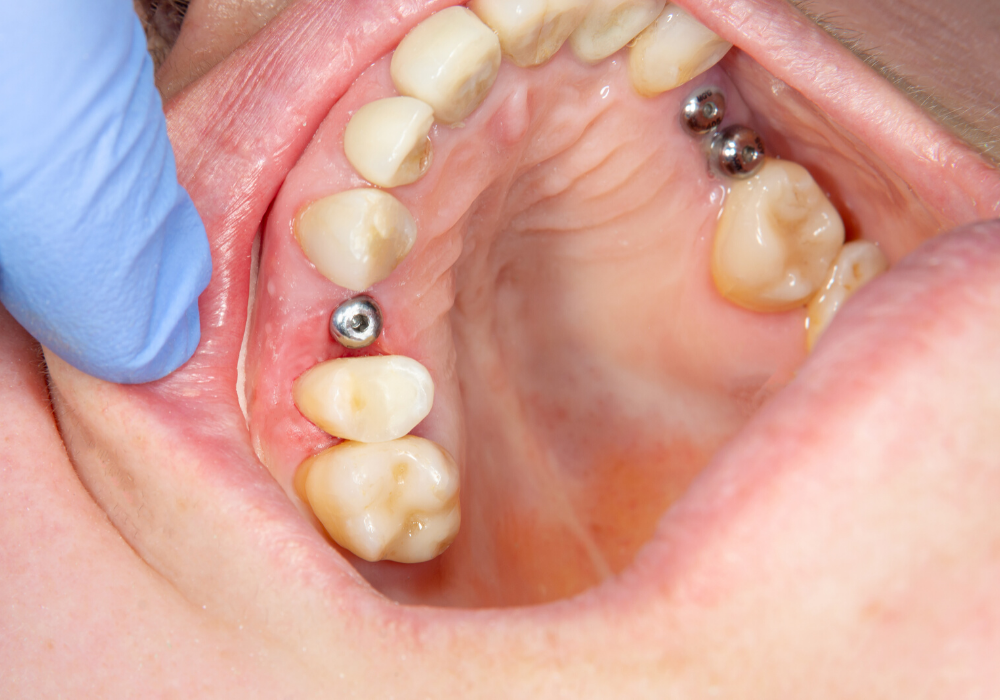 https://rddentalclinic.com/wp-content/uploads/2024/07/dental-implants-recovery.png