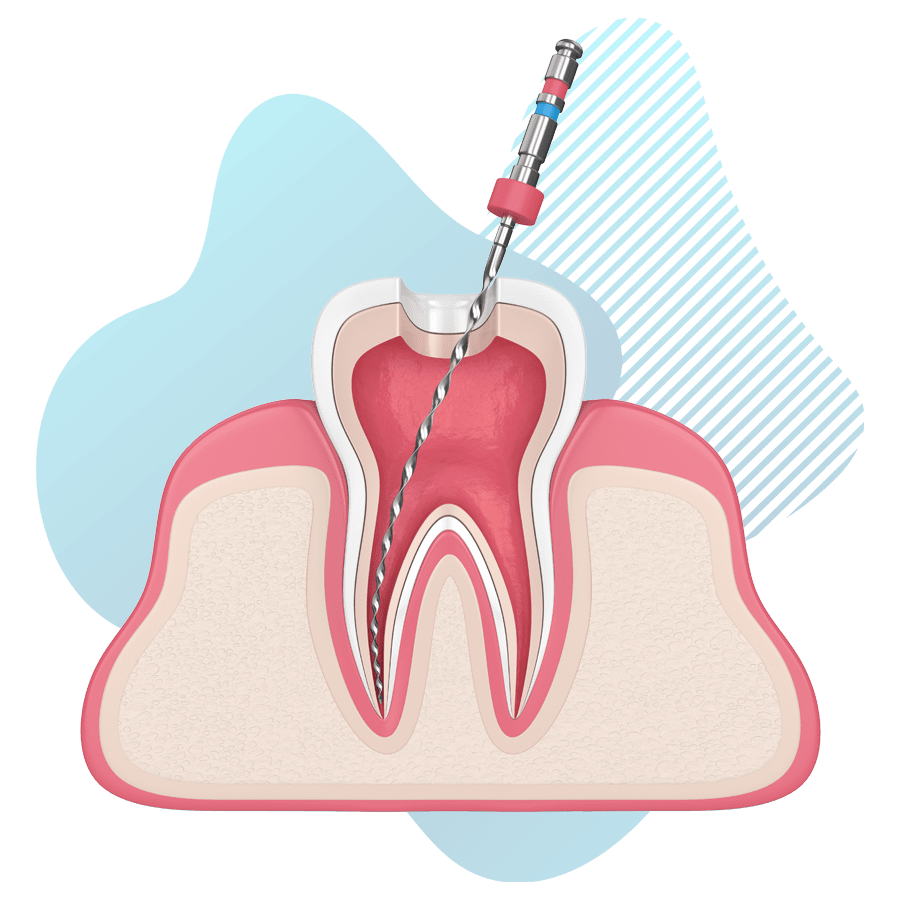 https://rddentalclinic.com/wp-content/uploads/2024/07/root-canal.png