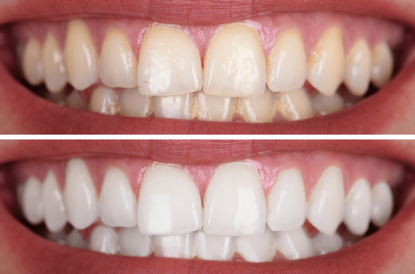 https://rddentalclinic.com/wp-content/uploads/2024/07/teeth-whitening.png